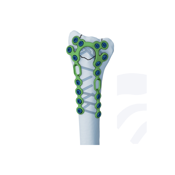 4.0ChLP Dorsale - placca Pi radiale Placca per telaio dorsale distale 2.5 Placca per compressione ossea Medartis Radius