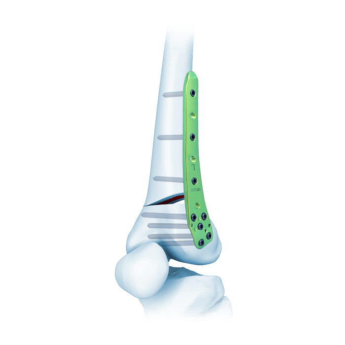 Placca TomoFix® per femore distale laterale