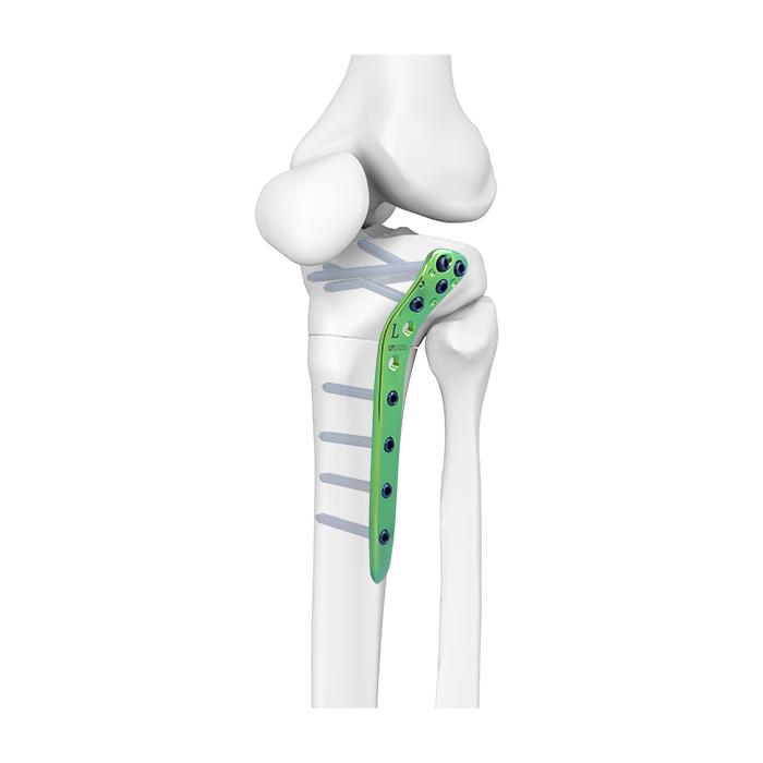 Placca prossimale per tibia laterale Synthes