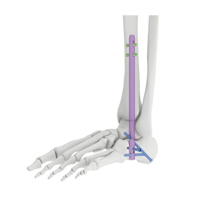 Ankle Arthrodesis Intramedullary Nail