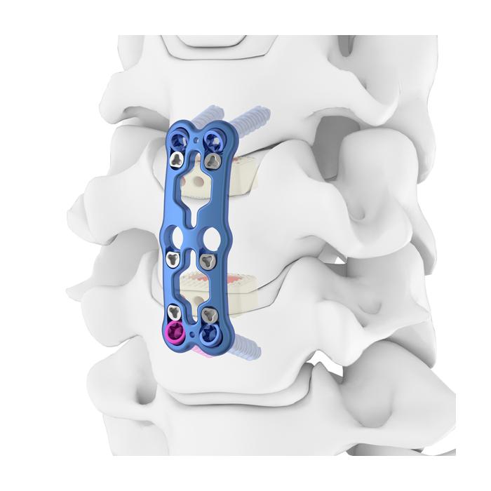 Placca di bloccaggio della colonna vertebrale cervicale anteriore ACP