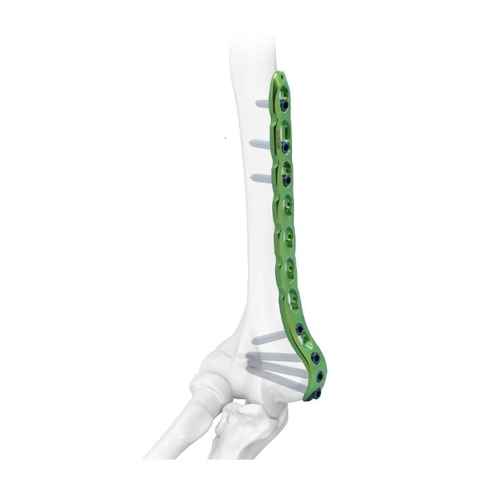 Distal Medial Humeral Reconstruction Locking  Plate, Twin Hole