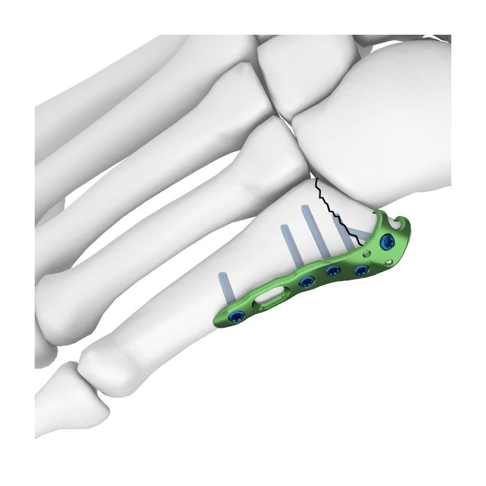 Ankle Foot Locking Plate Metatarsal Locking Plate