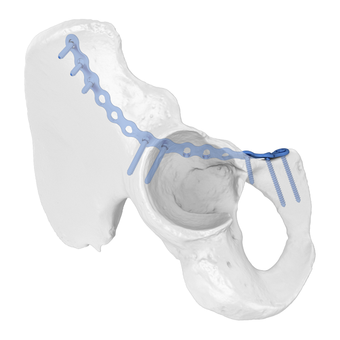 Placca acetabolare flessibile (FAP) Placca di bloccaggio anatomica della colonna anteriore iliopubica
