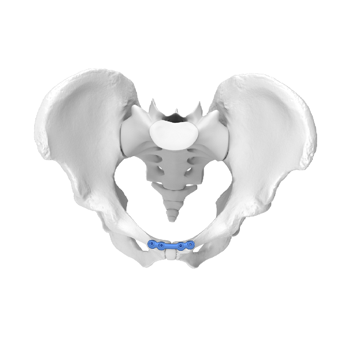 Flexible Acetabular Plate (FAP) System Symphysis Pubis Superior Anatomic Locking Plate
