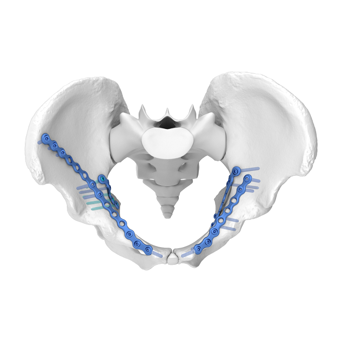 Flexible Acetabular Plate (FAP) System Iliosciatic Anatomic Locking Plate