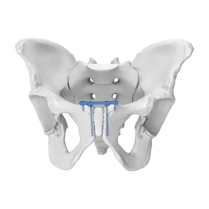 Placca acetabolare flessibile (FAP) Placca di bloccaggio anatomico superiore per sinfisi pubica
