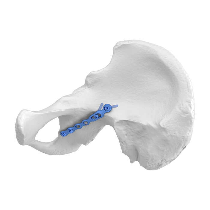 Placca acetabolare flessibile (FAP) Placca di bloccaggio anatomica iliosciatica, obliqua
