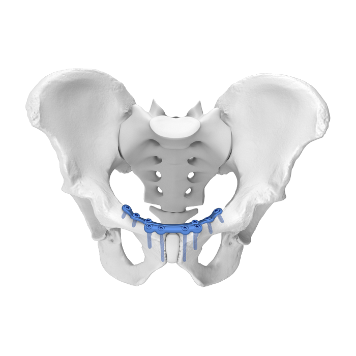 Flexible Acetabular Plate (FAP) System Symphysis Pubis Medial Anatomic Locking Plate