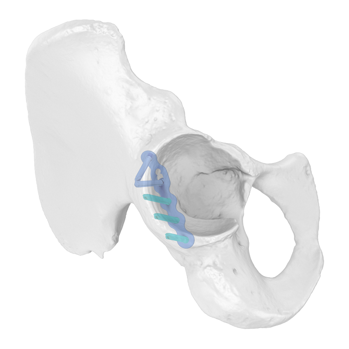 Placca acetabolare flessibile (FAP) Placca di bloccaggio anatomica iliosciatica
