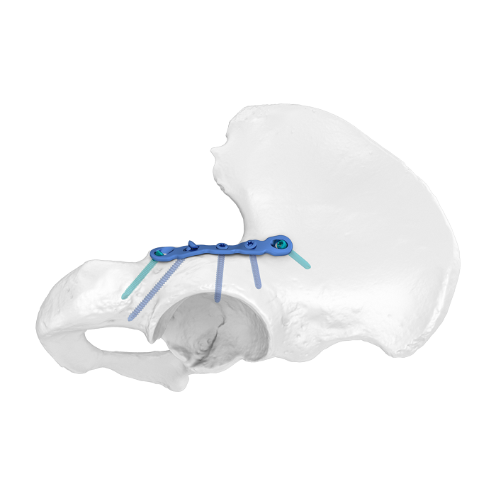 Sistema di piastre acetabolari flessibili (FAP) Piastra di bloccaggio anatomica della colonna posteriore
