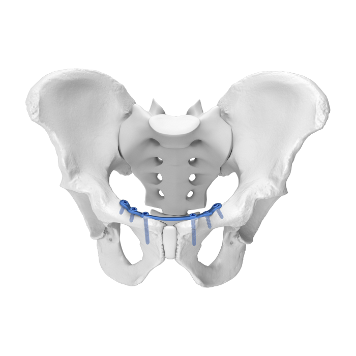 Placca acetabolare flessibile (FAP) Placca di bloccaggio anatomica per sinfisi pubica mediale
