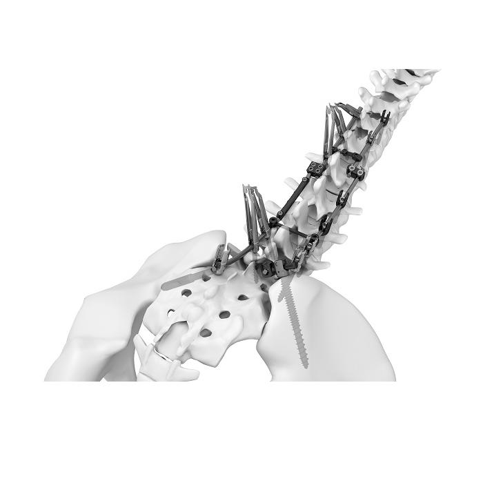 Sistema della colonna vertebrale TINA