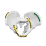 Piastra dell'articolazione sacroiliaca anteriore