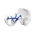 Placca di blocco acetabolare pelvica anatomica