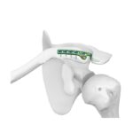 Clavicular Hook Locking Plate III