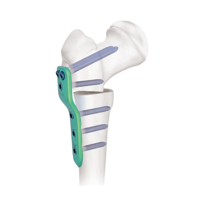Placca di bloccaggio per anca pediatrica da 2,7/3,5/5,0 mm