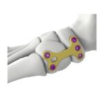 Placca di bloccaggio per fusione navicolare-cuneiforme Itval