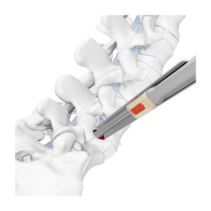 Gabbia Endoscopica Transforaminale Endo LIF