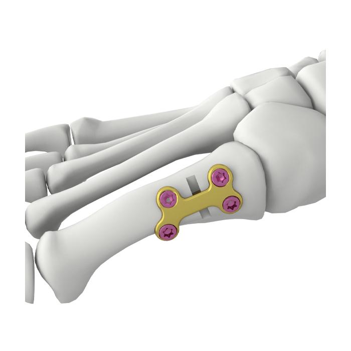 Placca di blocco per osteotomia del primo metatarso